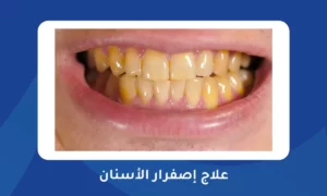 علاج إصفرار الأسنان