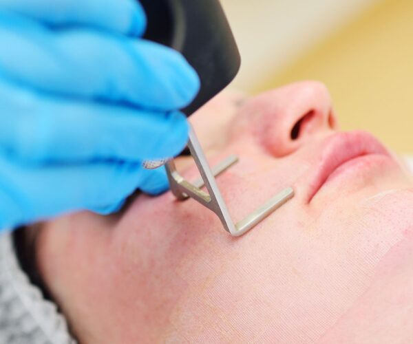 أفضل عروض ليزر بالرياض بأسعار تناسبك وتقنيات GentleLASE وSplendor X