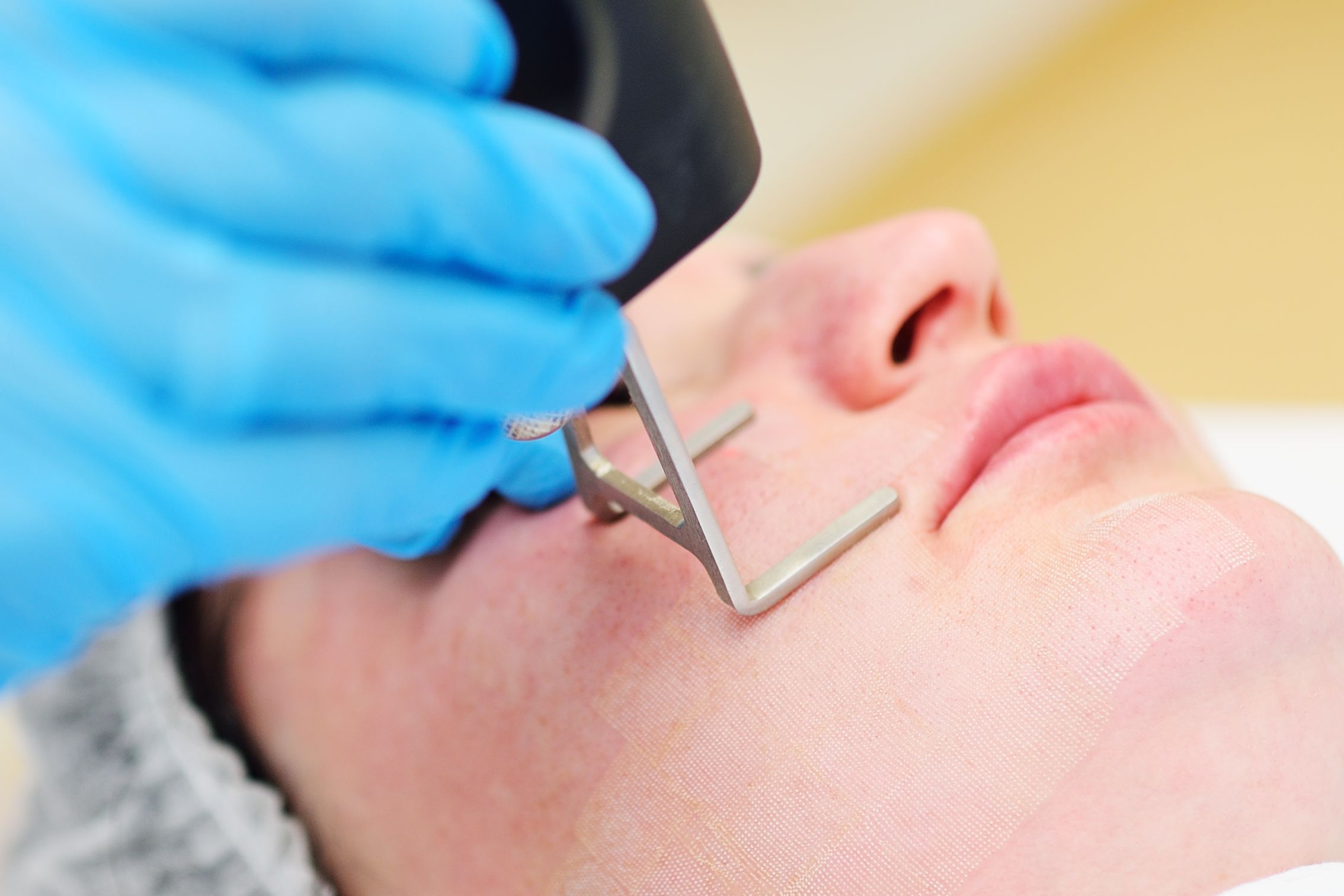 Read more about the article أفضل عروض ليزر بالرياض بأسعار تناسبك وتقنيات GentleLASE وSplendor X