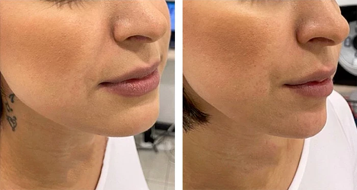 chin-filler-before-after-20231108085802.205549