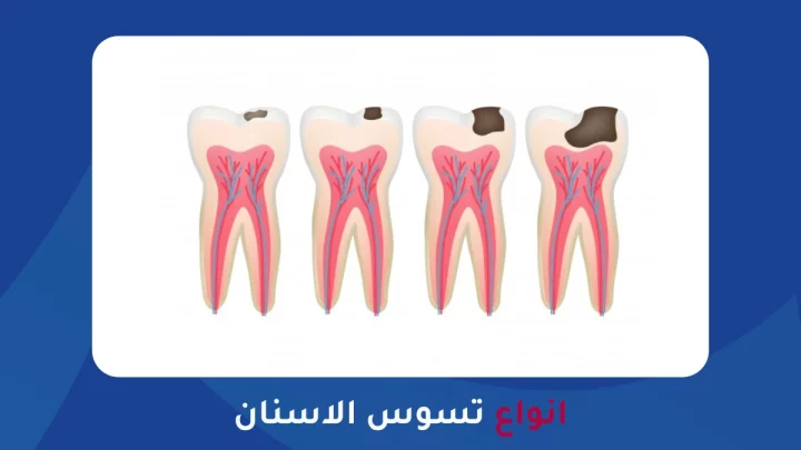 انواع تسوس الاسنان