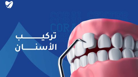 تركيب الاسنان