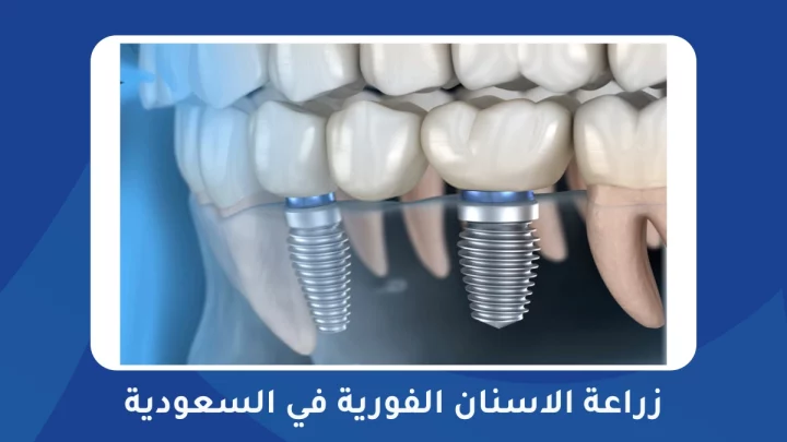 زراعة الاسنان الفورية في السعودية